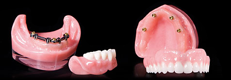 Implant-overdentures-Pic